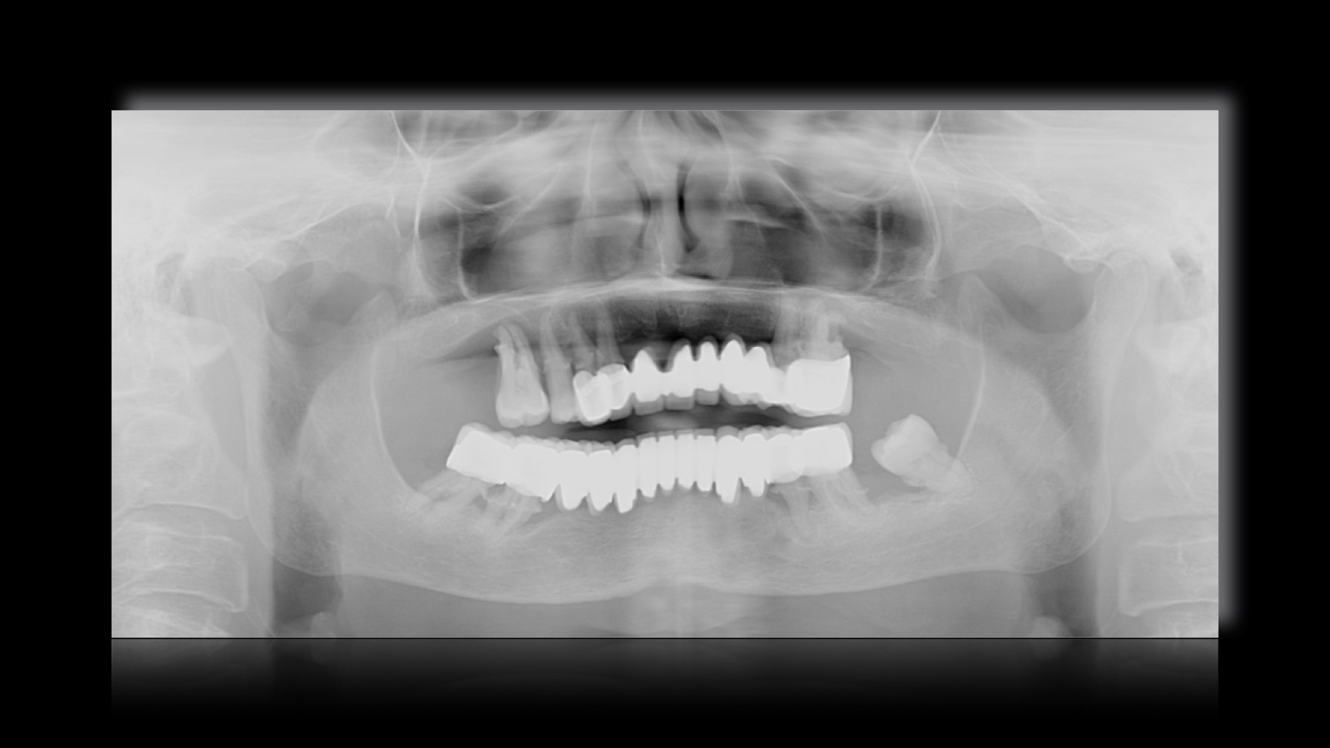 protesi iniziali su denti naturali